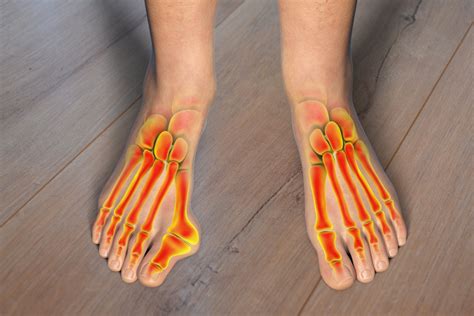 bunions treatment  surgery