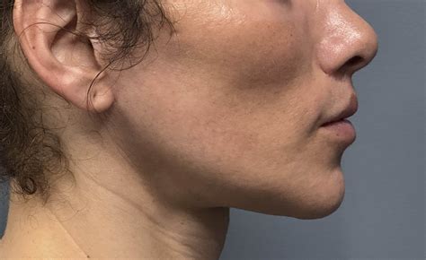 The secret behind what is a v line surgery results today