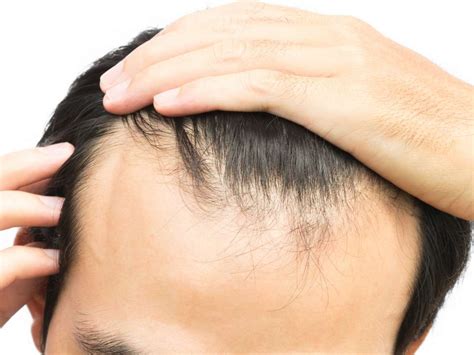 receding hairline stages  men women ds healthcare group