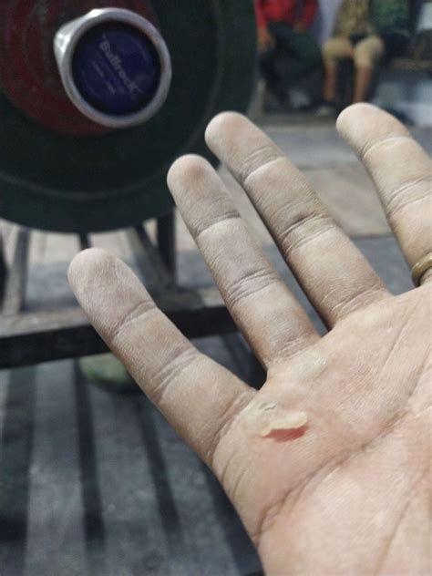 how to rid calluses on hands 8