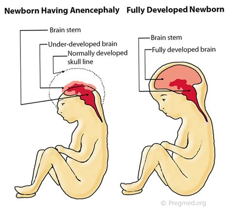Anencephaly; Aprosencephaly