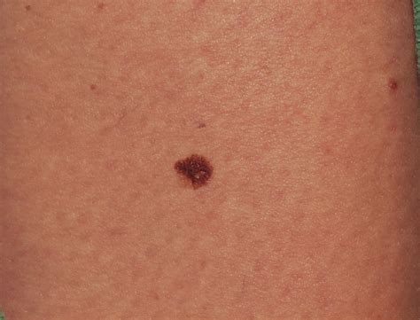 Melanoma Skin Cancer Skin Cancer Melanoma Non Melanom - vrogue.co