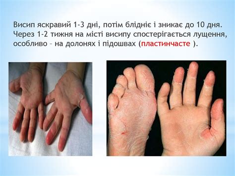 Кір, Краснуха, Вітряна віспа. Скарлатина, - презентация онлайн