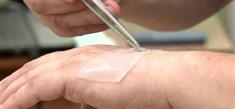 Раны заживают прямо на глазах: новый материал обезболивает и лечит