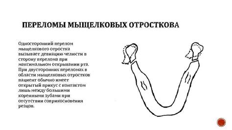 КЛАССИФИКАЦИЯ ПЕРЕЛОМОВ ВЕРХНЕЙ И НИЖНЕЙ ЧЕЛЮСТИ В