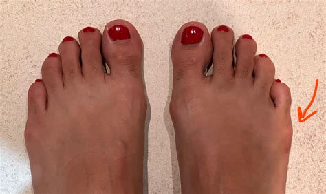 Do I have bunions + tailors’ bunions? The one next to the little toe on