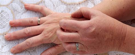 shingles     henry ford health detroit mi