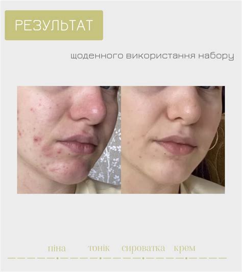 Закриті комедони. Що це? Як боротись?