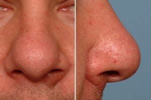 The Bulbous Nose Rhinoplasty - Explore Plastic Surgery
