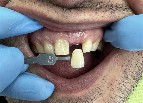 Коронка из диоксида циркония на импланте | Dentistry