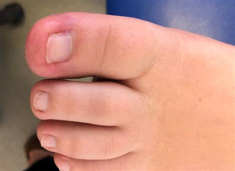 ingrown toenail with infection Fungal toenails and onychomycosis