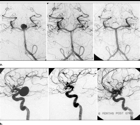 (a) Left: Ruptured basilar tip aneurysm in a 56-year-old woman. The ...