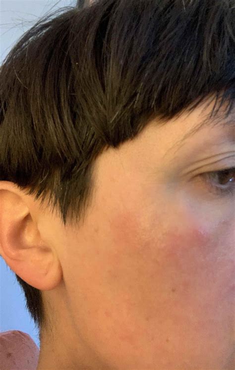 Is this a rosacea symptom? Raised red patch near my eye, almost like a
