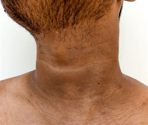 Acanthosis nigricans — Medical Secrets