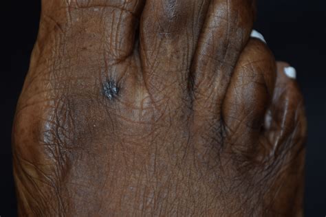 Skin Cancer Photo Gallery