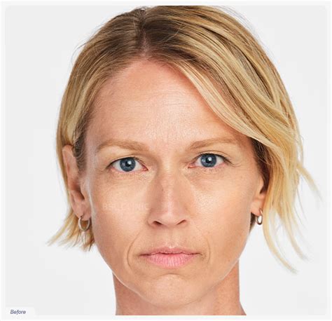 Radiesse Program: Initial Volumizing & Collagen Stimulating