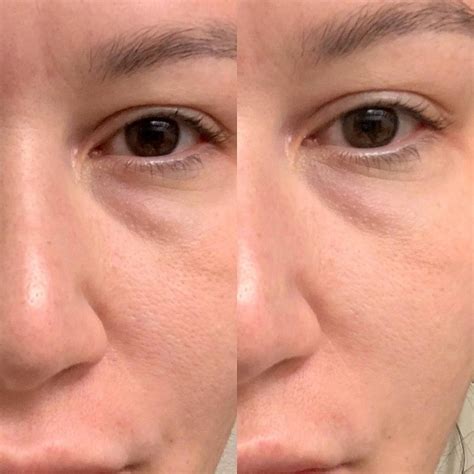 The Ordinary Peeling Solution Before and After: A Comprehensive Review ...