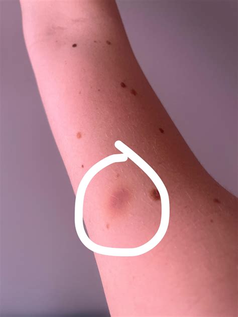 Painless spot on forearm : r/DermatologyQuestions