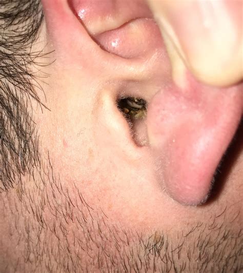 Blackheads In Ear Canal