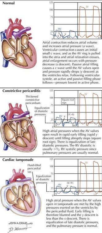 Pericardial Disease: Diagnosis and Hemodynamics | Thoracic Key