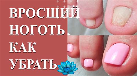 Вросший ноготь на большом пальце. Выравнивание ногтей. - YouTube