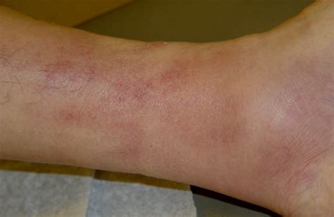 Povrchový zánět žil, thromboflebitis superficialis - příznaky, projevy ...