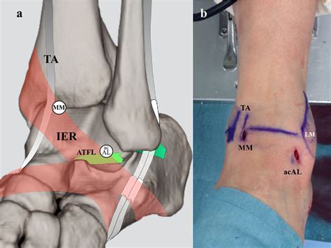 Inferior extensor retinaculum | Semantic Scholar