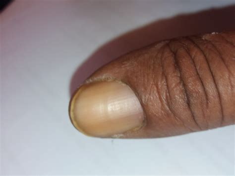 Absent lunula of the thumbnail | Download Scientific Diagram