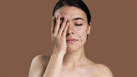 salicylic acid  acne benefits dosages side effects healthshots