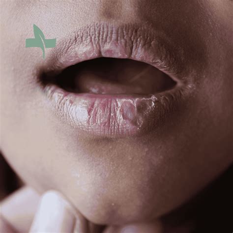 chapped lips  symptoms  treatments sagemed