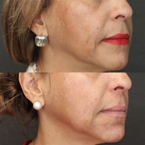 Chemical Peel - Before and After | Dana Point Dermatology