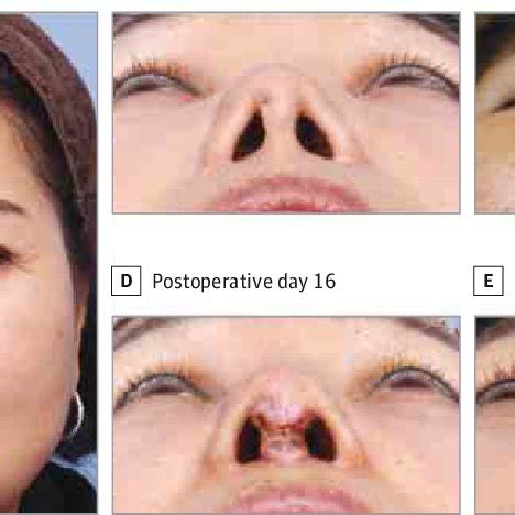 Columellar Skin Necrosis Preoperative scar contracture A | Download Scientific Diagram