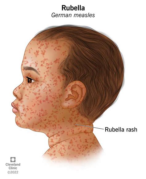 Rubella (German Measles): Symptoms, Treatment & Prevention