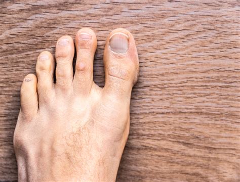 Брадавици: видове и лечение | DR—DENKOVA DERMATOLOGY