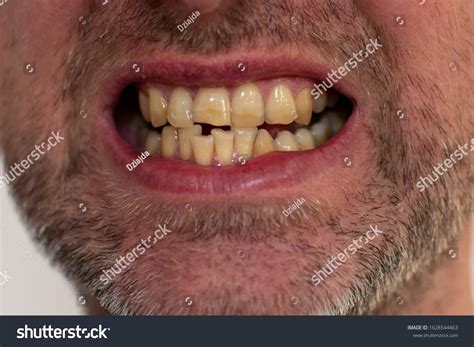 3,368 Weird Teeth Images, Stock Photos & Vectors | Shutterstock