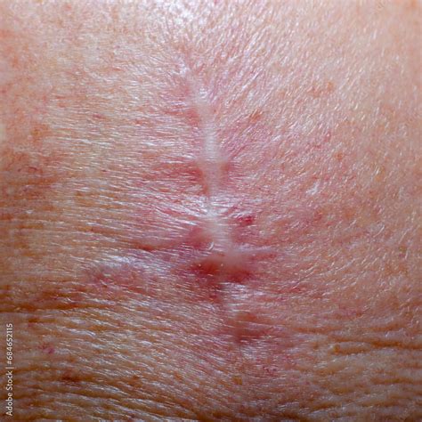 scar  threads  removal  skin cancer   head stock photo