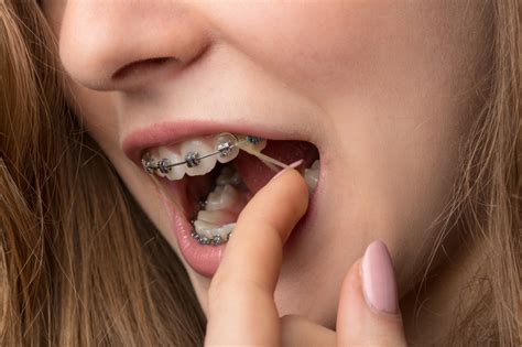 How Important Is it to Wear Your Orthodontic Rubber Bands? - Belmar ...