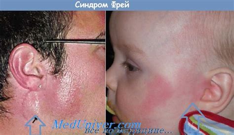 Синдром Фрей (Frey) - синонимы, авторы, клиника