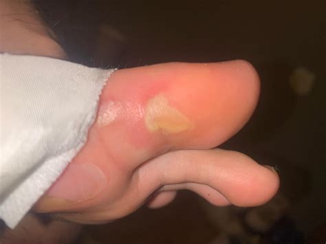 Infected blister? : r/woundcare