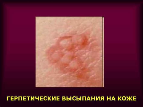ЛЕКЦИЯ ГЕРПЕСВИРУСЫ. ОБЩАЯ