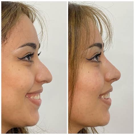 nose    age   nose filler