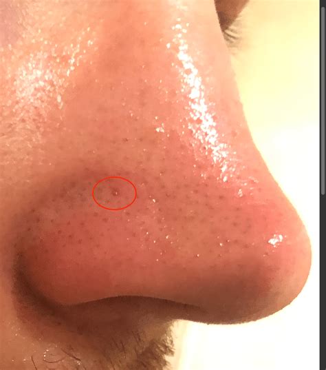 squeezing giant blackheads 2023