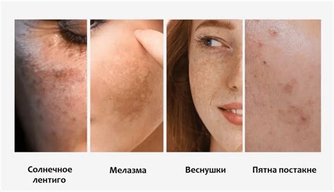 Пигментация и пигментные пятна: почему появляются, что это и как от них ...