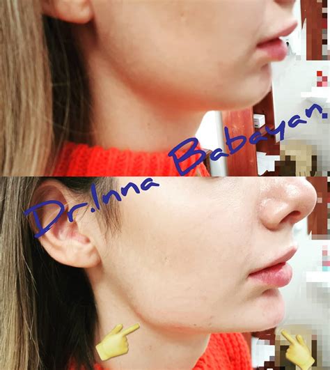 Prime Med Clinic by Dr.Babayan - Оформяне на долната челюст с ...