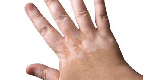 obat penyakit kulit belang putih obat vitiligo ampuh  aman