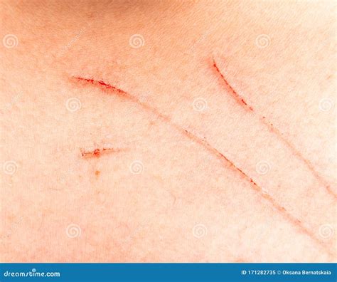 Scratches on the Skin of a Child Stock Image - Image of child, inflammation: 171282735