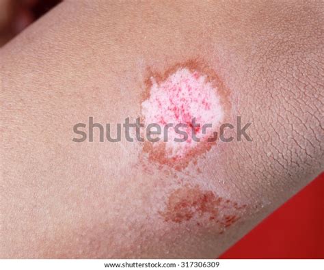 close  scraped bleeding elbow stock photo  shutterstock