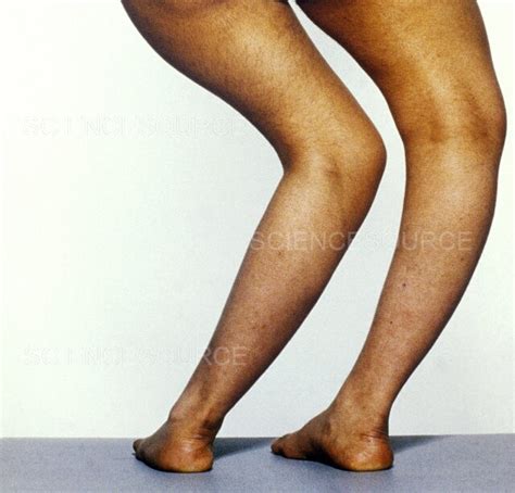 Rickets | Stock Image - Science Source Images