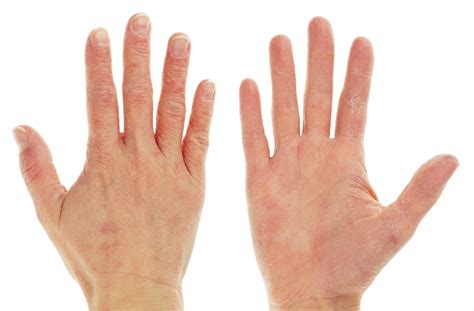 How To Treat And Avoid Dry Cracked Hands - Seven Stars Fitness