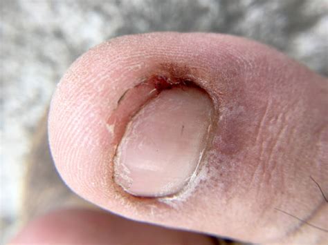 Curved Toenails Stock Photos, Pictures & Royalty-Free Images - iStock